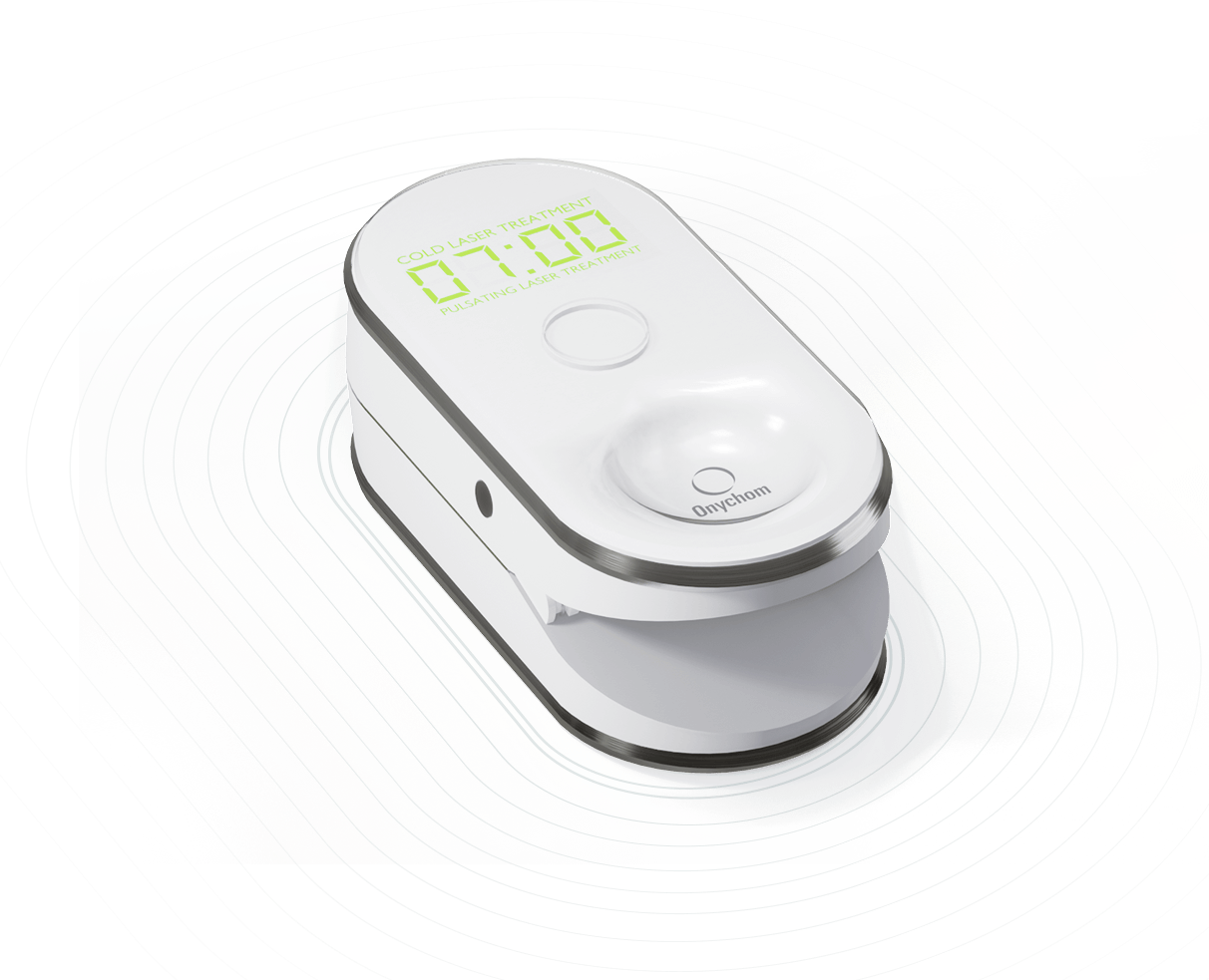 Onychom Antifungal Laser Device Dermachom.co.uk